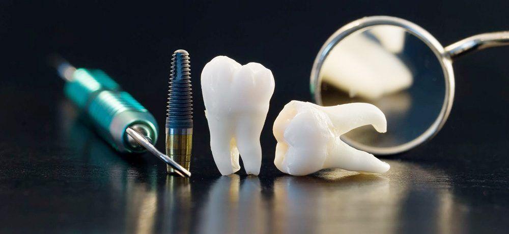 Zubni implantat ili zubni most, što je bolje?
