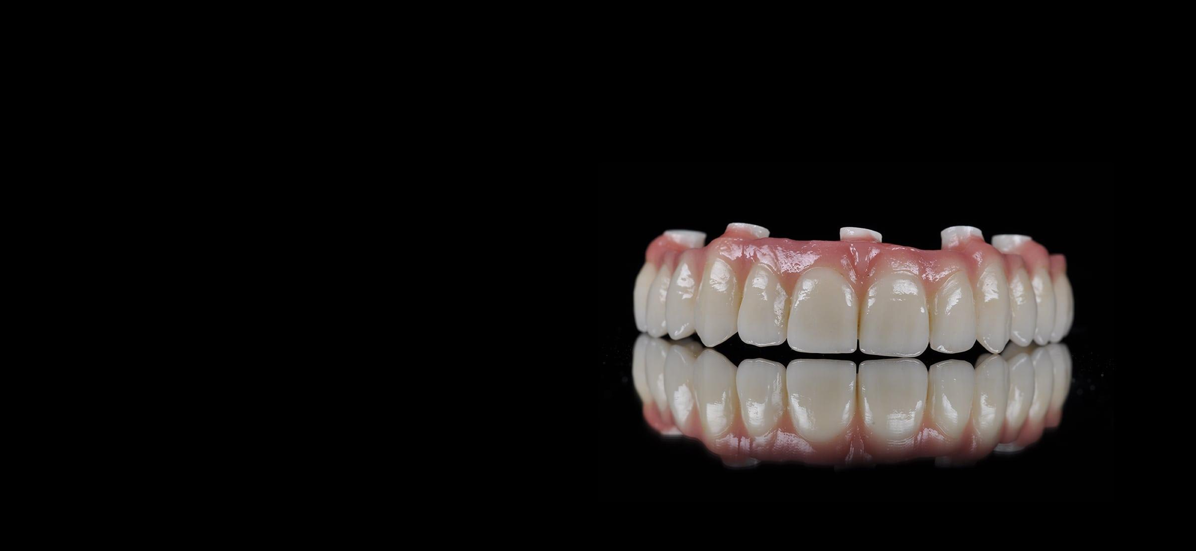 Zubni mostovi na implantatima