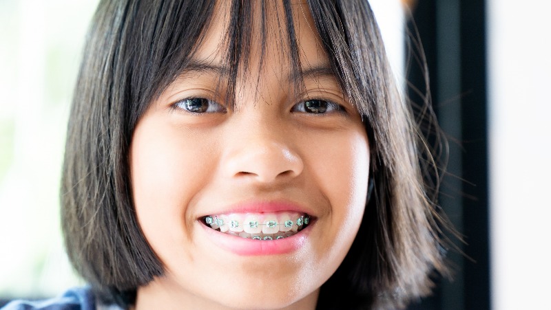 Apparecchio ortodontico fisso