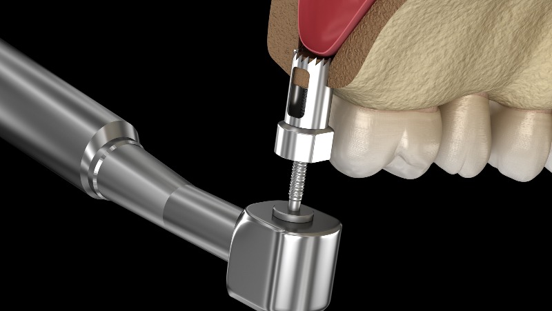 Sinus Lift: Procedura per rinforzare la struttura ossea della mascella superiore