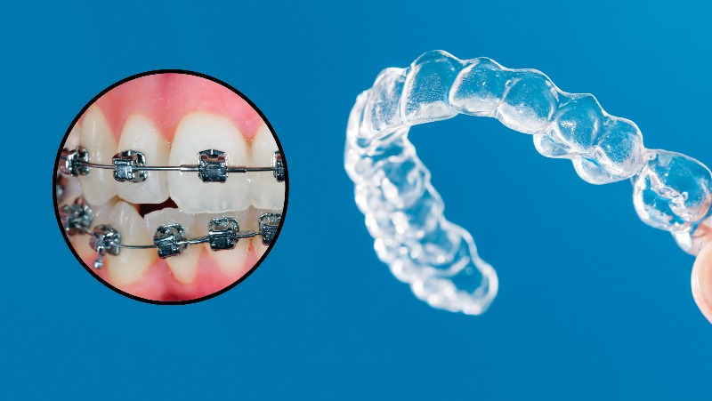 Cos’ è l’ortodonzia e perché è importante?