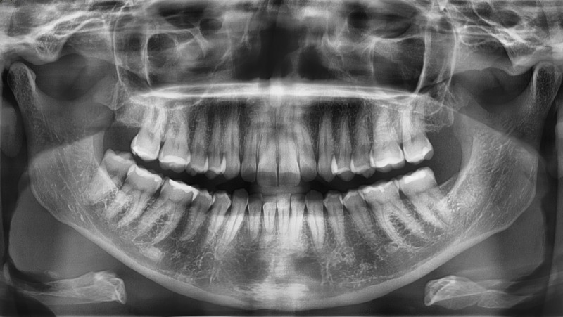 Ortopanoramica digitale, RVG e CBCT