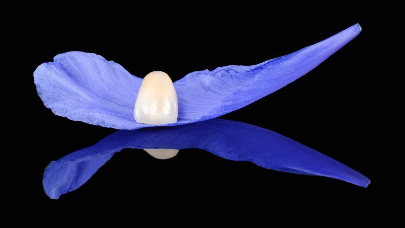Faccette in ceramica (Veneers)